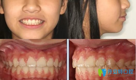 找<!--<i data=20240703-sp></i>-->口腔楊占娟做牙齒矯正后照片