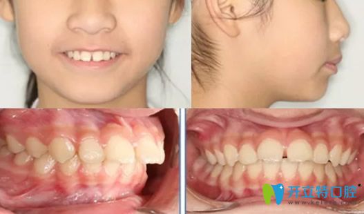 <!--<i data=20240703-sp></i>-->口腔楊占娟齙牙矯正前