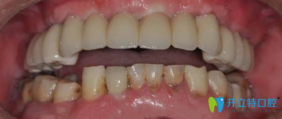 張叔戴上牙冠后 張叔戴上牙冠后