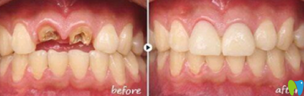 田忠奎醫(yī)生牙齒種植代表案例 田忠奎醫(yī)生牙齒種植代表案例