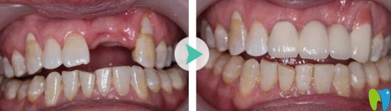 福州維樂口腔張俊偉怎么樣？看牙齒種植案例效果