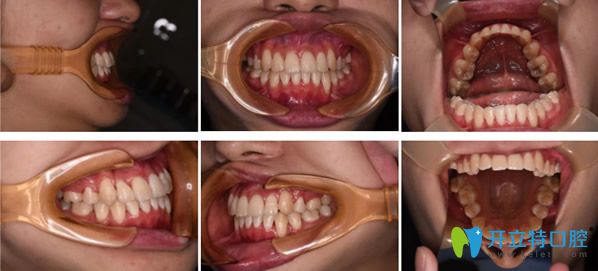 青島拜博口腔矯正牙齒一年半后效果
