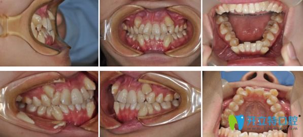 青島拜博口腔矯正牙齒前