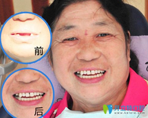 拜博口腔種植牙齒前后對(duì)比照 拜博口腔種植牙齒前后對(duì)比照