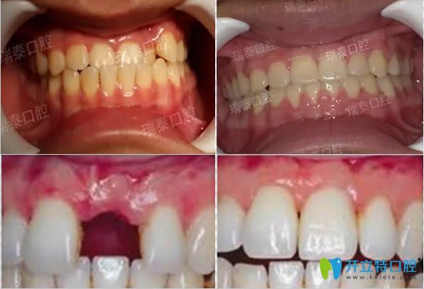 青島瑞泰地包天矯正及門牙缺失種植前后對(duì)比效果