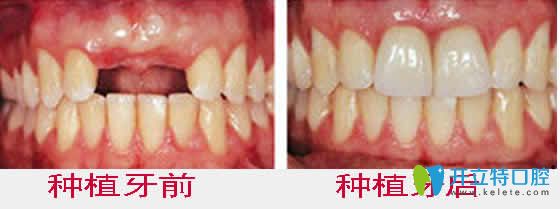 <!--<i data=20240703-sp></i>-->齒科種植牙前后效果對比圖 <!--<i data=20240703-sp></i>-->齒科種植牙前后效果對比圖