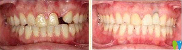 拜博口腔單顆牙缺失種植效果對(duì)比 拜博口腔單顆牙缺失種植效果對(duì)比