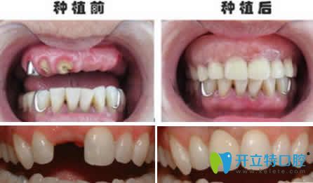 <!--<i data=20240703-sp></i>-->齒科<!--<i data=20240703-sp></i>-->種植牙案例效果圖 <!--<i data=20240703-sp></i>-->齒科<!--<i data=20240703-sp></i>-->種植牙案例效果圖