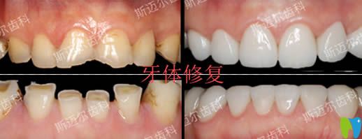 北京斯邁爾齒科楊雷牙齒美學(xué)修復(fù)效果圖