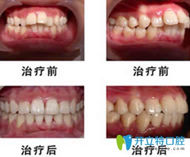 <!--<i data=20240703-sp></i>-->齒科<!--<i data=20240703-sp></i>-->牙齒矯正對(duì)比圖 <!--<i data=20240703-sp></i>-->齒科<!--<i data=20240703-sp></i>-->牙齒矯正對(duì)比圖