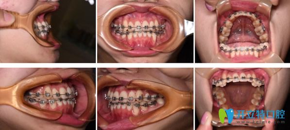 金屬托槽矯正牙齒進行中