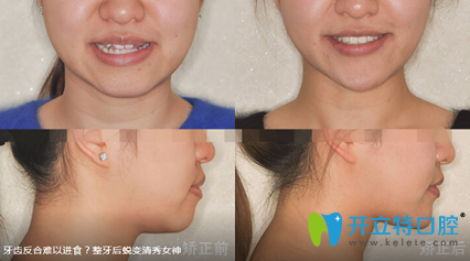 楊國平反咬合矯正案例對比圖