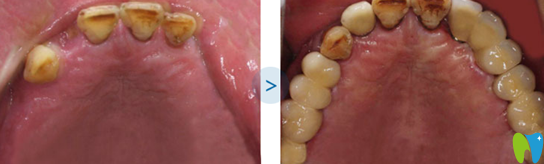 徐震武多顆牙缺失種植案例種植后對比圖