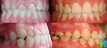 北京斯邁爾齒科骨性錯(cuò)合牙齒正畸效果圖