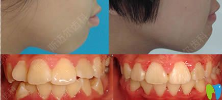 北京斯邁爾口腔牙齒不齊/噘嘴矯正效果圖