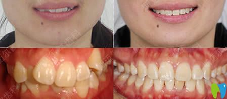 北京斯邁爾齒科怎么樣?看牙齒不齊和齙牙矯正對比效果圖