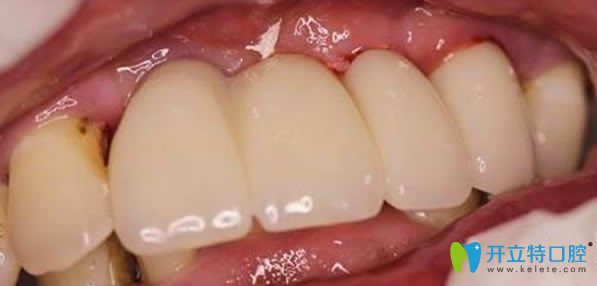 佳士潔口腔多顆牙缺失微創(chuàng)無痛種植牙術(shù)后效果圖 佳士潔口腔多顆牙缺失微創(chuàng)無痛種植牙術(shù)后效果圖