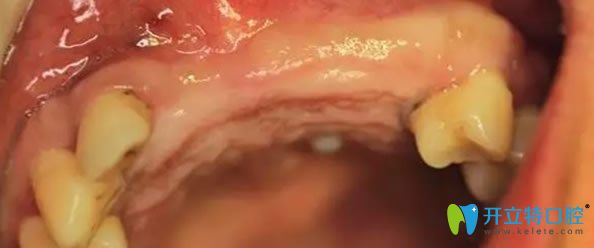 無錫佳士潔口腔半口牙缺失種植牙前 無錫佳士潔口腔半口牙缺失種植牙前