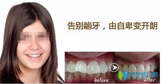 佛山壹加壹齙牙矯正前后對比照片