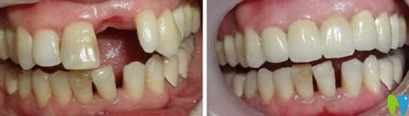 羅新宇院長(zhǎng)種植牙代表案例