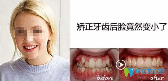 壹加壹口腔隱適美矯正牙齒效果