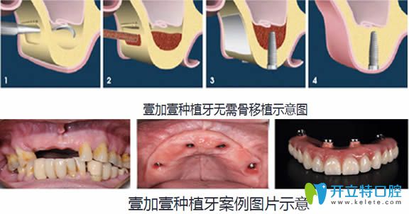 合肥壹加壹無(wú)需骨移植圖示及種植牙案例圖
