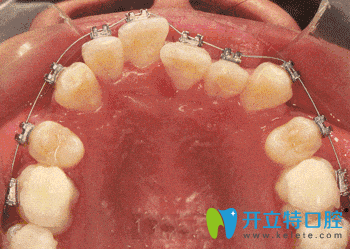 自鎖托槽矯正牙齒進(jìn)行中