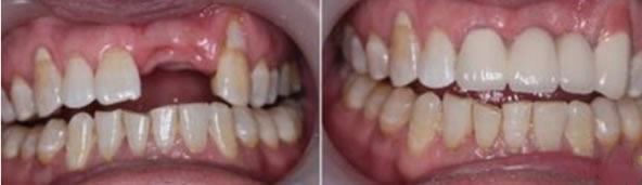 種植牙齒多少錢   即刻種植牙術(shù)后效果清晰可見(jiàn)