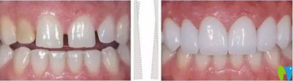 李向飛口腔瓷貼面修復效果 李向飛口腔瓷貼面修復效果