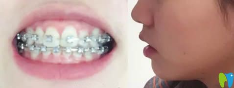 去泰安光彩口腔帶牙套10個(gè)月效果圖 去泰安光彩口腔帶牙套10個(gè)月效果圖