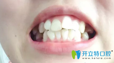 泰安光彩口腔做牙齒矯正前 泰安光彩口腔做牙齒矯正前