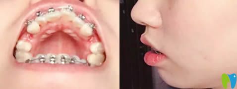 在光彩口腔戴牙套第1天照片 在光彩口腔戴牙套第1天照片