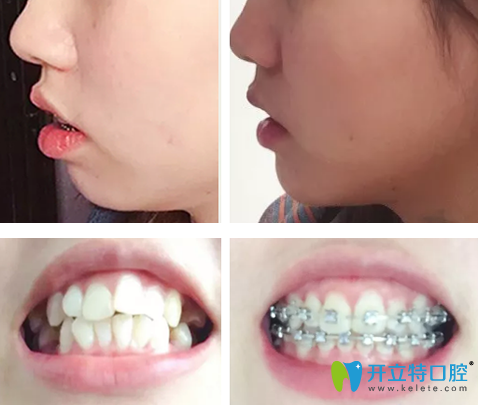 齙牙怎么矯正？曬泰安光彩口腔鋼絲矯正齙牙1-10個月變化圖