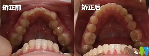 牙齒擁擠怎么辦?花2.4萬讓福州維樂口腔郭淑蘋給我做了矯正