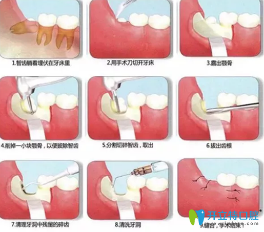 阻生智齒拔出過程圖