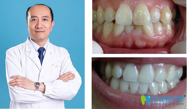 李向飛醫(yī)生和他矯正牙齒前后效果對(duì)比照