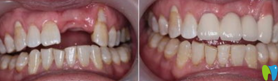 無(wú)錫牙博士口腔門牙缺失即刻種植牙代表案例