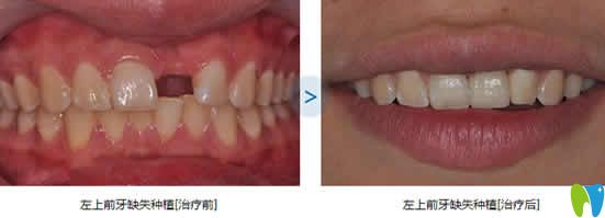 泉州維樂(lè)口腔謝燕峰種植牙案例效果圖