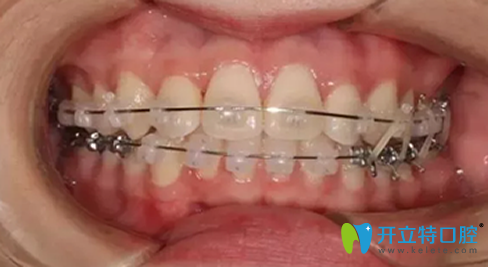 福州維樂口腔牙齒矯正5個月照片