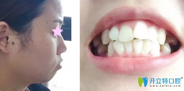 石家莊李向飛口腔矯正牙齒前