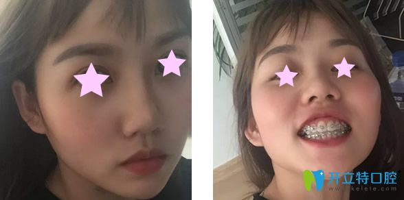 金屬托槽矯正牙齒10個(gè)月效果