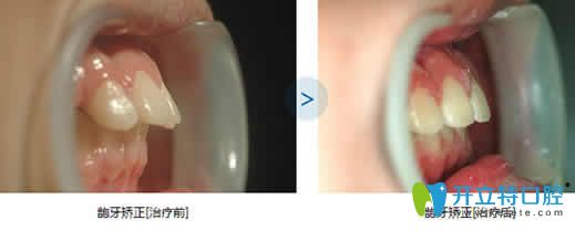 泉州維樂口腔齙牙矯正前后效果對(duì)比圖