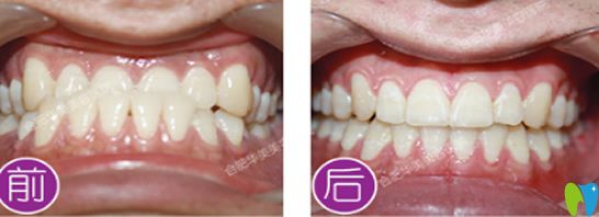 合肥華美口腔靠譜嗎？看華美牙齒矯正案例效果對比圖