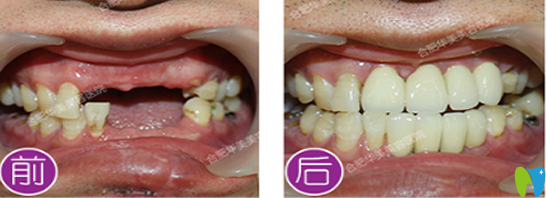 合肥華美口腔好不好？看華美種植牙案例效果展示