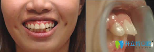 我在泉州維樂口腔做齙牙矯正前后對比圖及真實經(jīng)歷分享