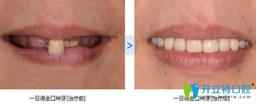 泉州維樂口腔全口種植牙前后對(duì)比圖