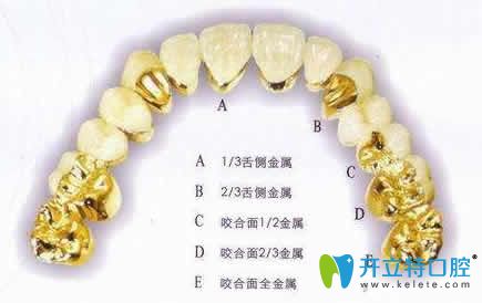 牙醫(yī)分享:套筒冠義齒怎樣收費及價格是多少錢