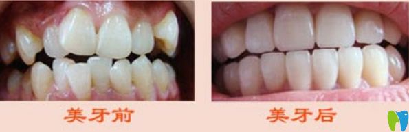 二氧化鋯全瓷牙修復(fù)牙齒<span style=