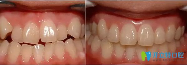 天津美萊口腔正畸前后對(duì)比照片