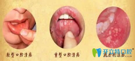 口腔潰瘍的治療方法